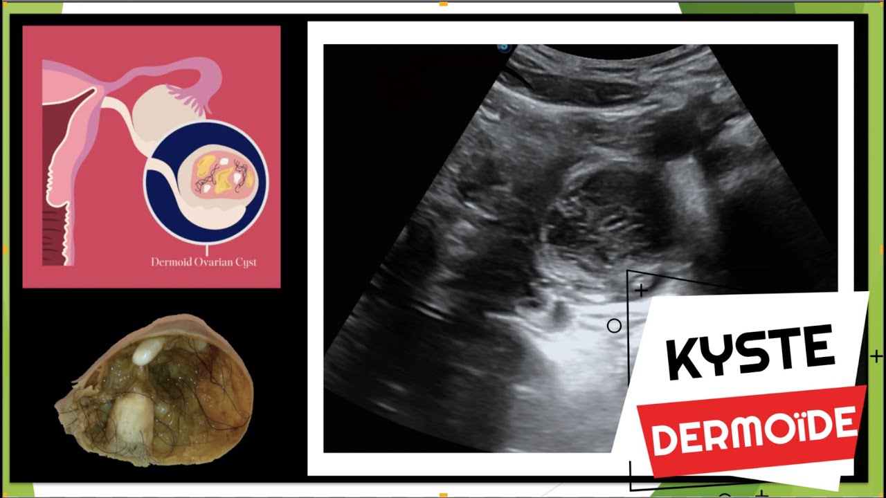 Echographie de l'ovaire: kyste dermoide