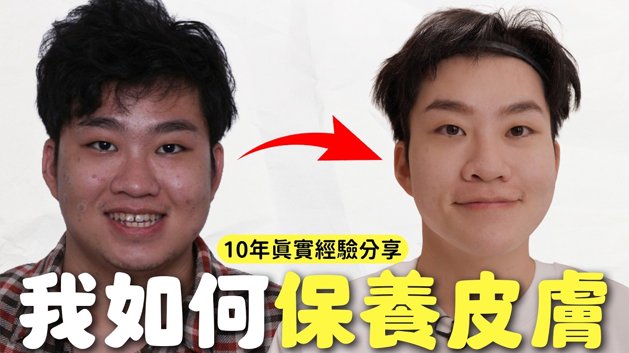 我10年痘痘爛臉的抗痘心得 ！【Joeman】