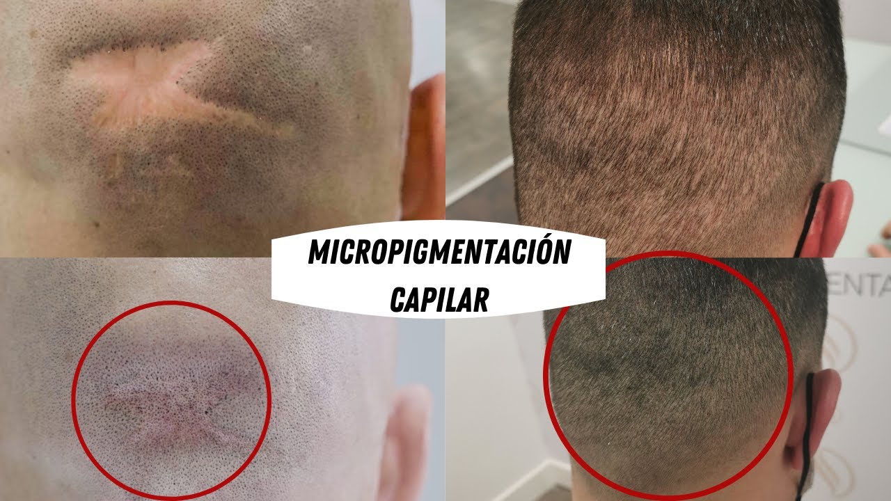 MICROPIGMENTACIÓN CAPILAR // QUÉ ES // PRECIO // CUANDO SE PUEDE HACER // 2021