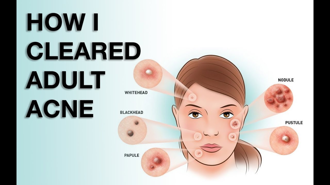 WHERE HAVE YOU BEEN?! Aka HOW I CLEARED MY ADULT ACNE