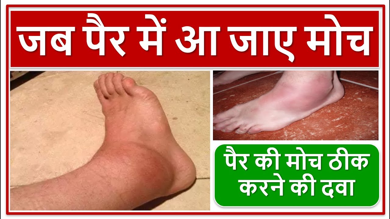 जब पैर में आ जाए मोच, पैर की मोच ठीक करने की दवा, मांसपेशियों की जकड़न की दवा, Muscle Spasm Medicine