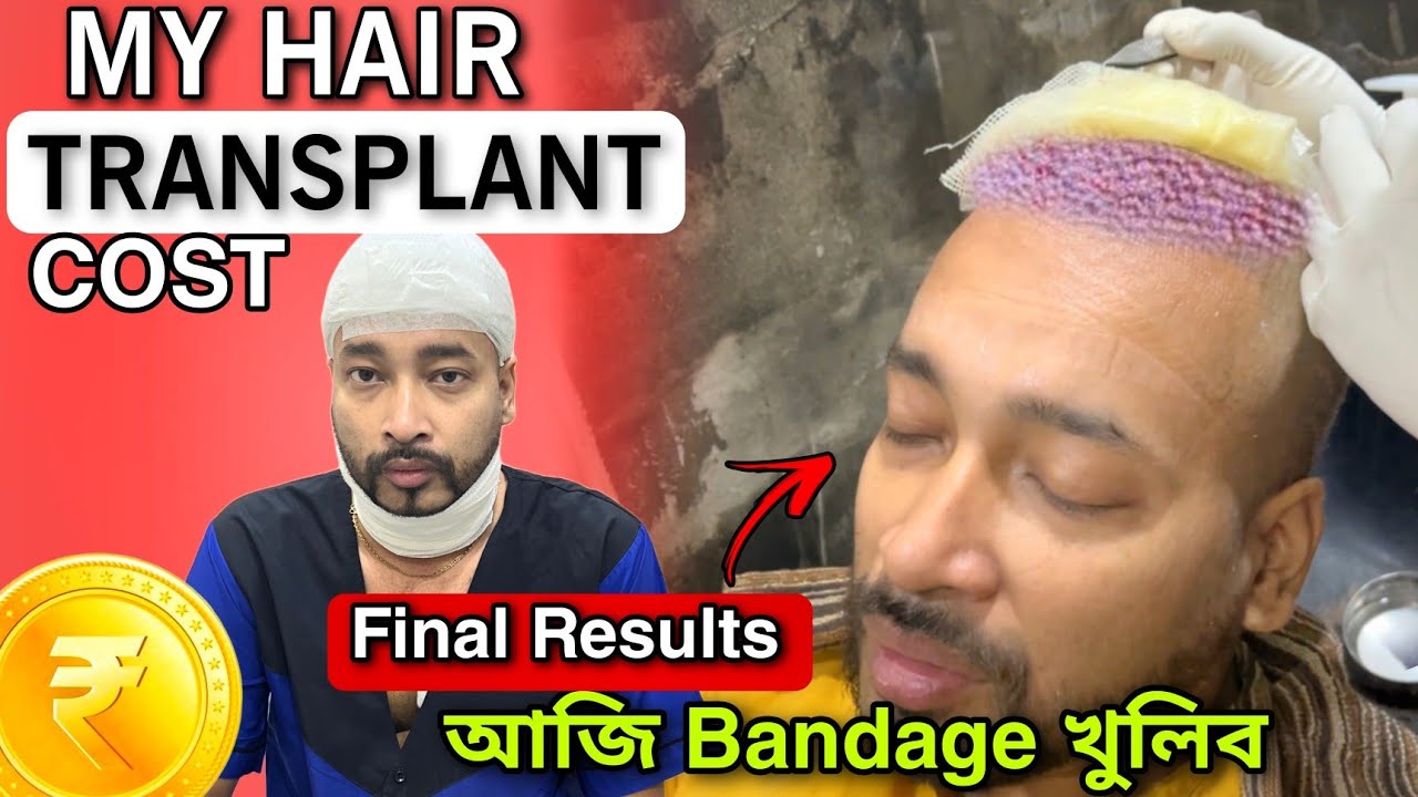 Hair Transplantৰ Final Result | Bandage খুলোতে কিয় হ'ল এনেকুৱা? কিমান খৰচ পৰিছিল Transplantত