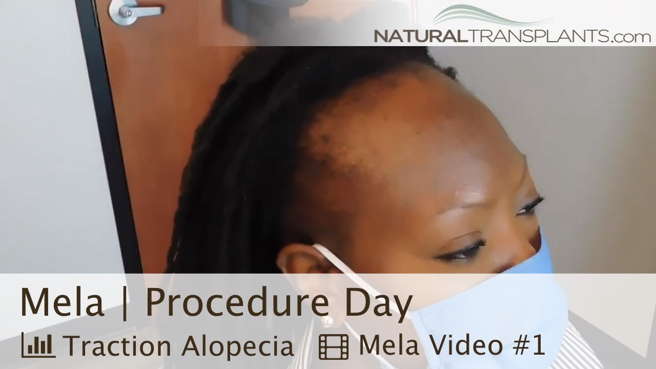 Hair Transplant Forehead Reduction Procedure for Traction Alopecia | Dr. Matt Huebner (Mela)