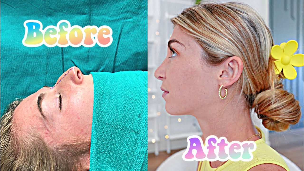 NOSE JOB UPDATE 1 Year Later! Was it worth it?!