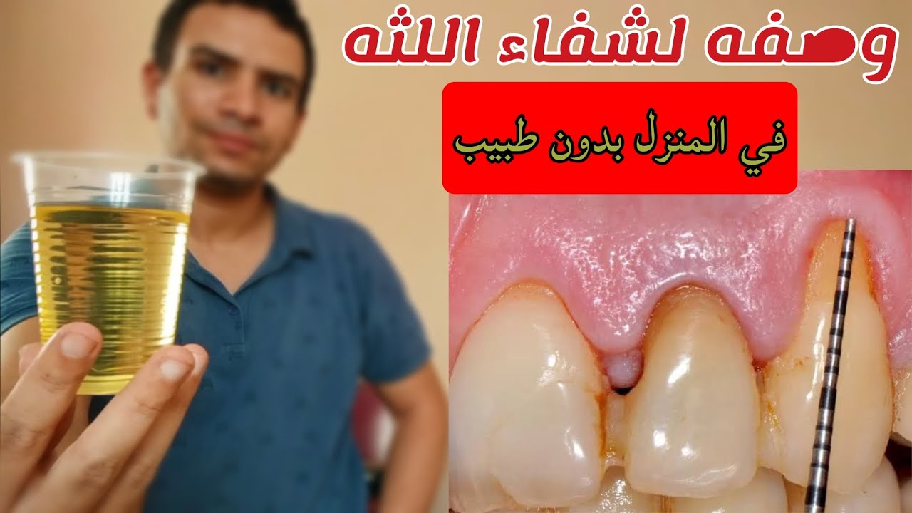 اسرع وصفه لشفاء اللثه تلقائيا توقف التراجع و تعالج الالتهاب خلال ايام