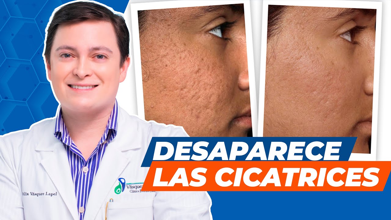 Atenuación de cicatrices con láser de CO2 fraccionado en Lima, Perú