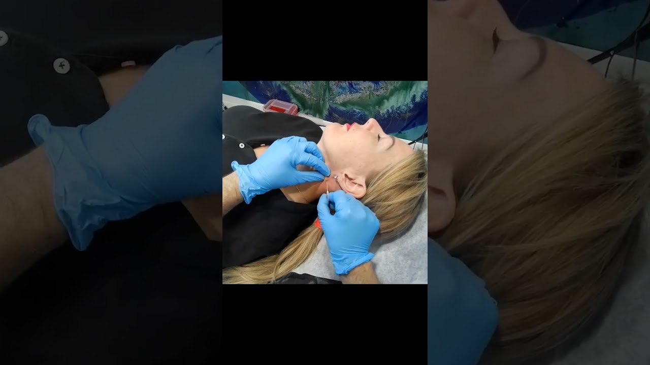 Best PDO Thread Lift in West Palm Beach | Marionette Lines Treatment in Palm Beach Gardens, Florida