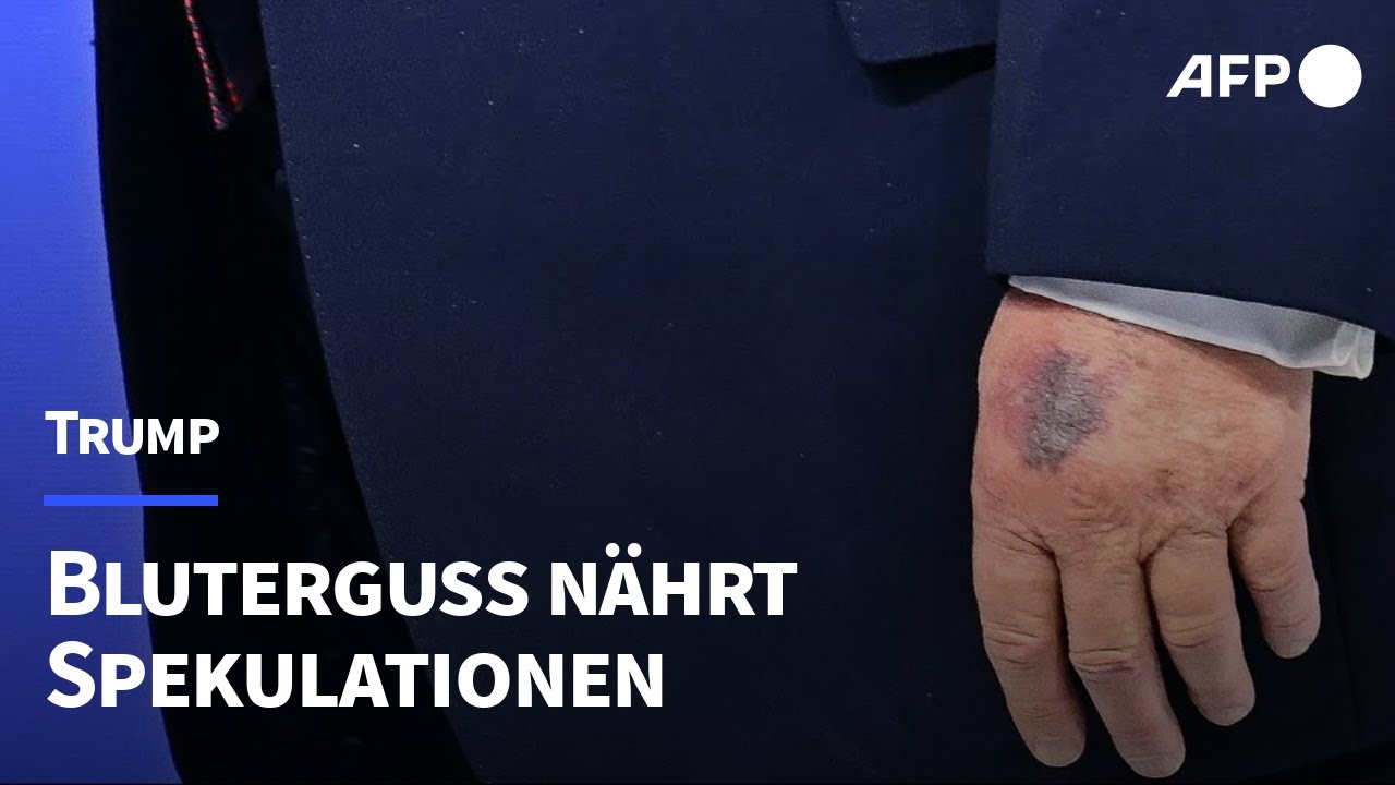 Bluterguss nährt neue Spekulationen über Trumps Gesundheit | AFP