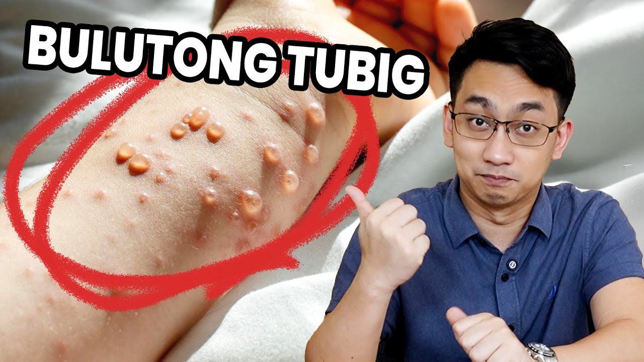 Bulutong Tubig: Ano ba ito? | Dr. Dex Macalintal