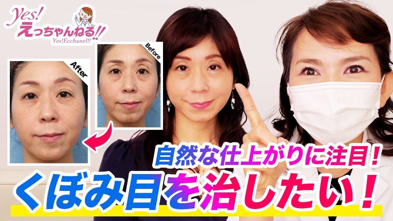 くぼみ目をなおしたい！ヒアルロン酸注射で目のくぼみを改善します