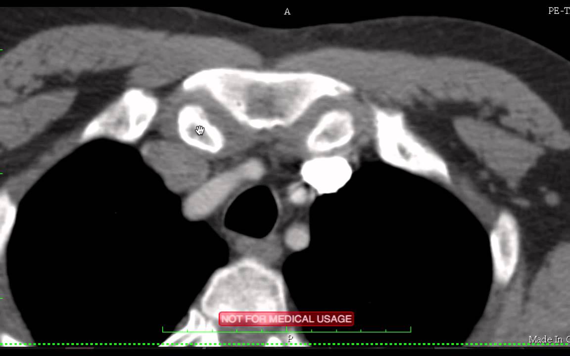Mediastinal Cross Sectional Anatomy on CT DISCUSSION by Radiologist