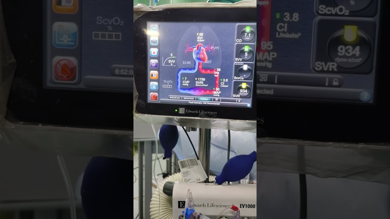 flowtrac machine | Measures Cardiac output