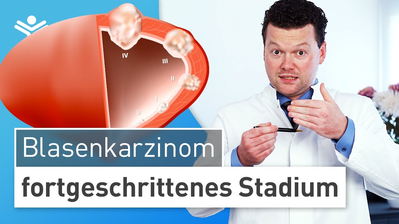 Blasenkrebs im fortgeschrittenen Stadium: Wann muss die Blase entfernt werden?