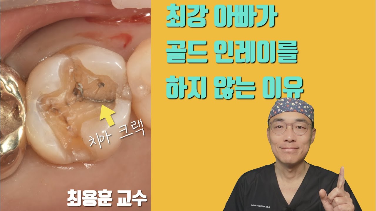 골드 인레이의 단점과 해결책 #치아살리기 #1회신경치료 #판교최용훈치과 #판교최용훈치과