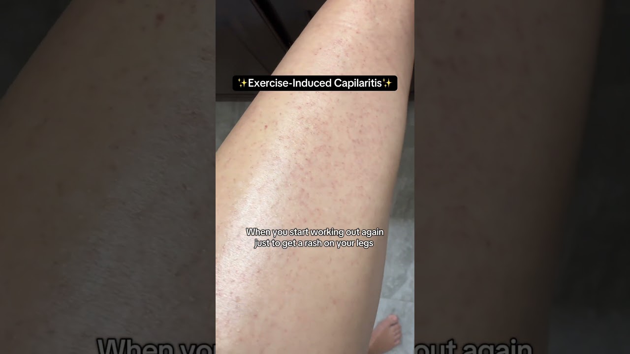 Why You Get Red Spots on Your Legs After Running 🏃&zwj;♀️ | Dermatologist Explains