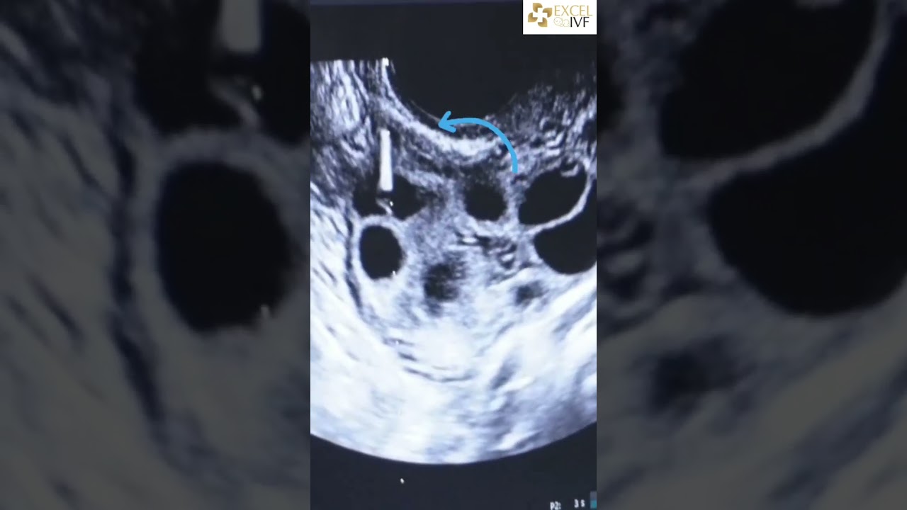 From Follicles to Fertility: The Egg Retrieval Journey! ❤️Dr Rhythm Gupta -IVF specialist #ytshorts