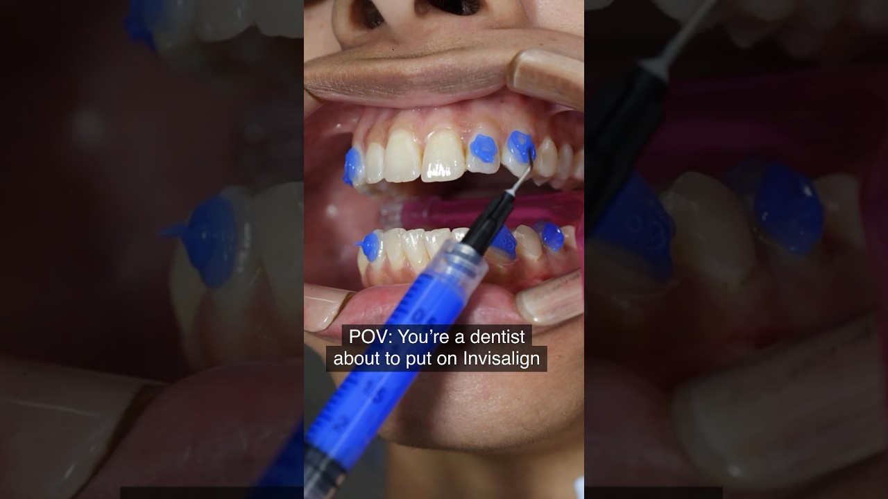 Элайнеры Invisalign