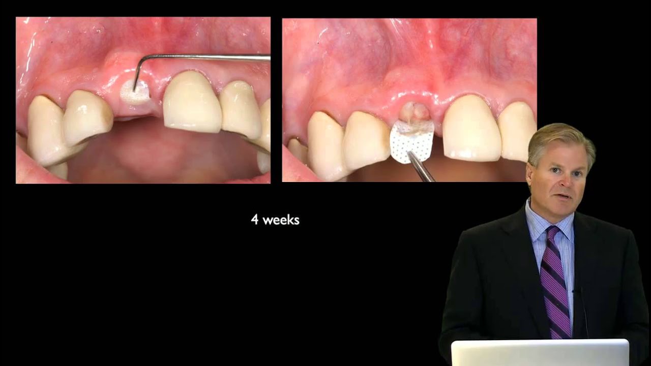 249-00 Alveolar Ridge Preservation for Implant and Pontic Site Development PREVIEW
