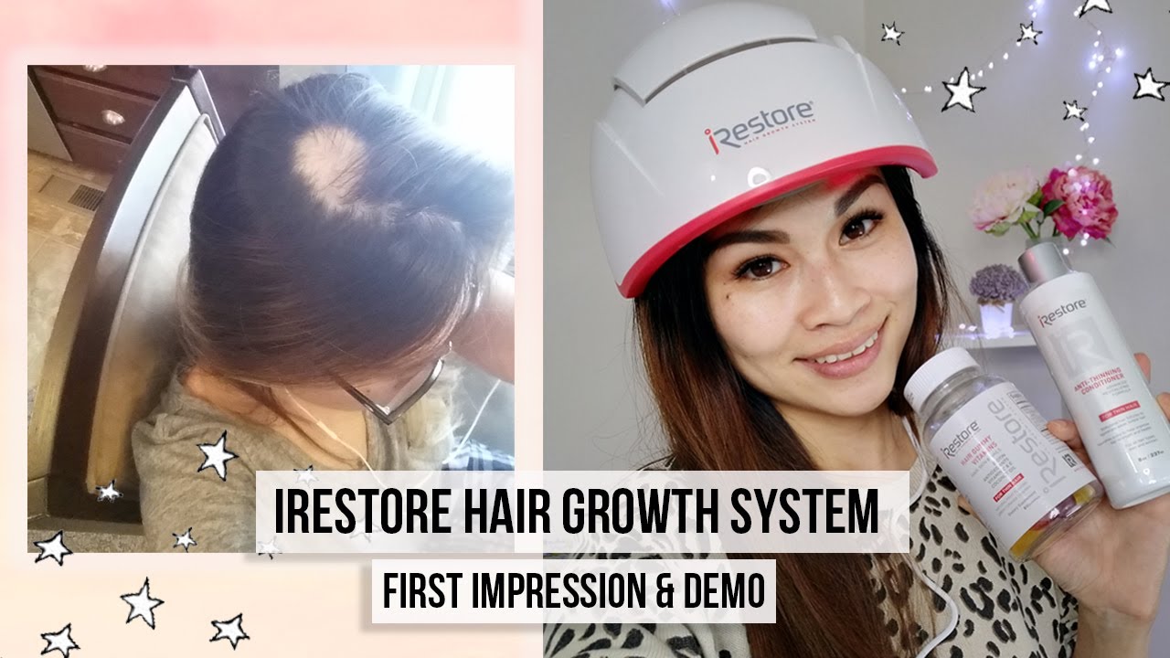 My ALOPECIA AREATA 2 yr UPDATE⎮ iRestore Pro Laser Hair Growth System First Impression & Demo