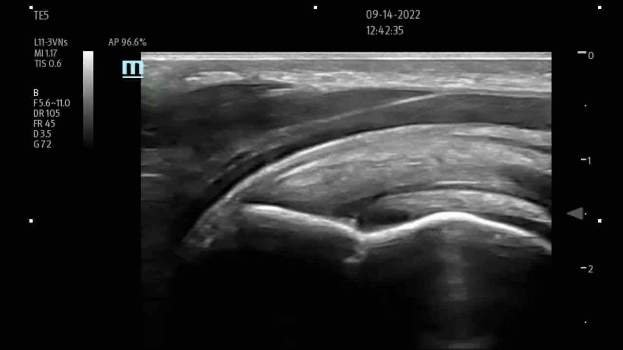 What does a partial thickness rotator cuff tear look like on ultrasound?