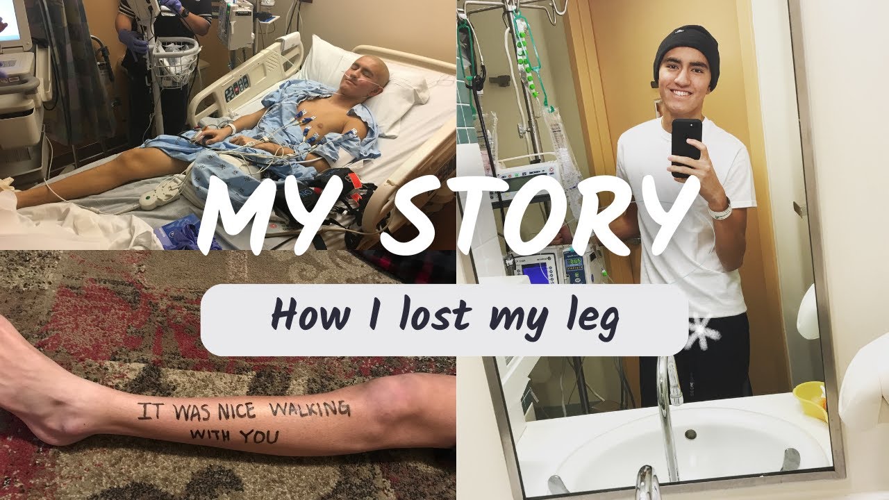 How I Lost My Leg - My Cancer Story