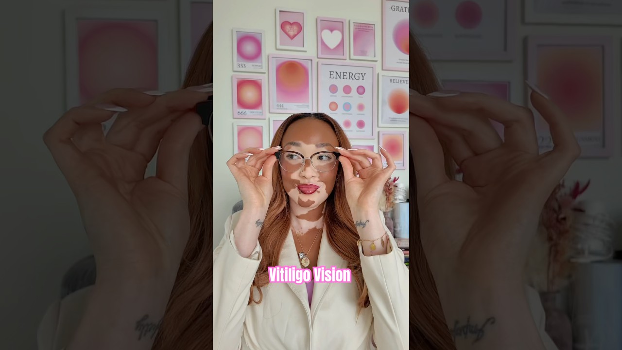 Vitiligo Vision: What is Vitiligo? 🤔 #vitiligotreatment #vitiligo
