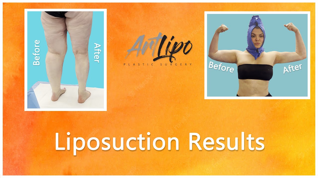 Lipo 360&deg; | Liposuction Results | High-Definition | Expert Dr. Thomas Su