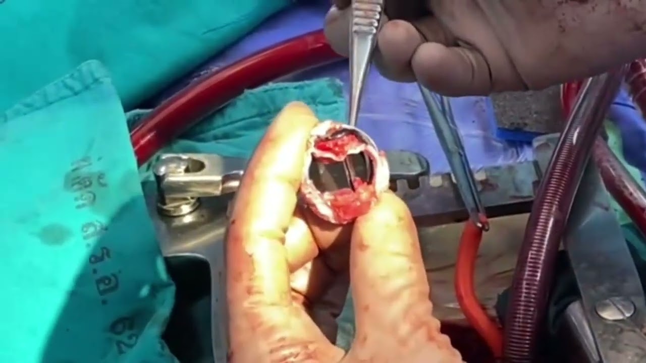 prosthetic valve dysfn