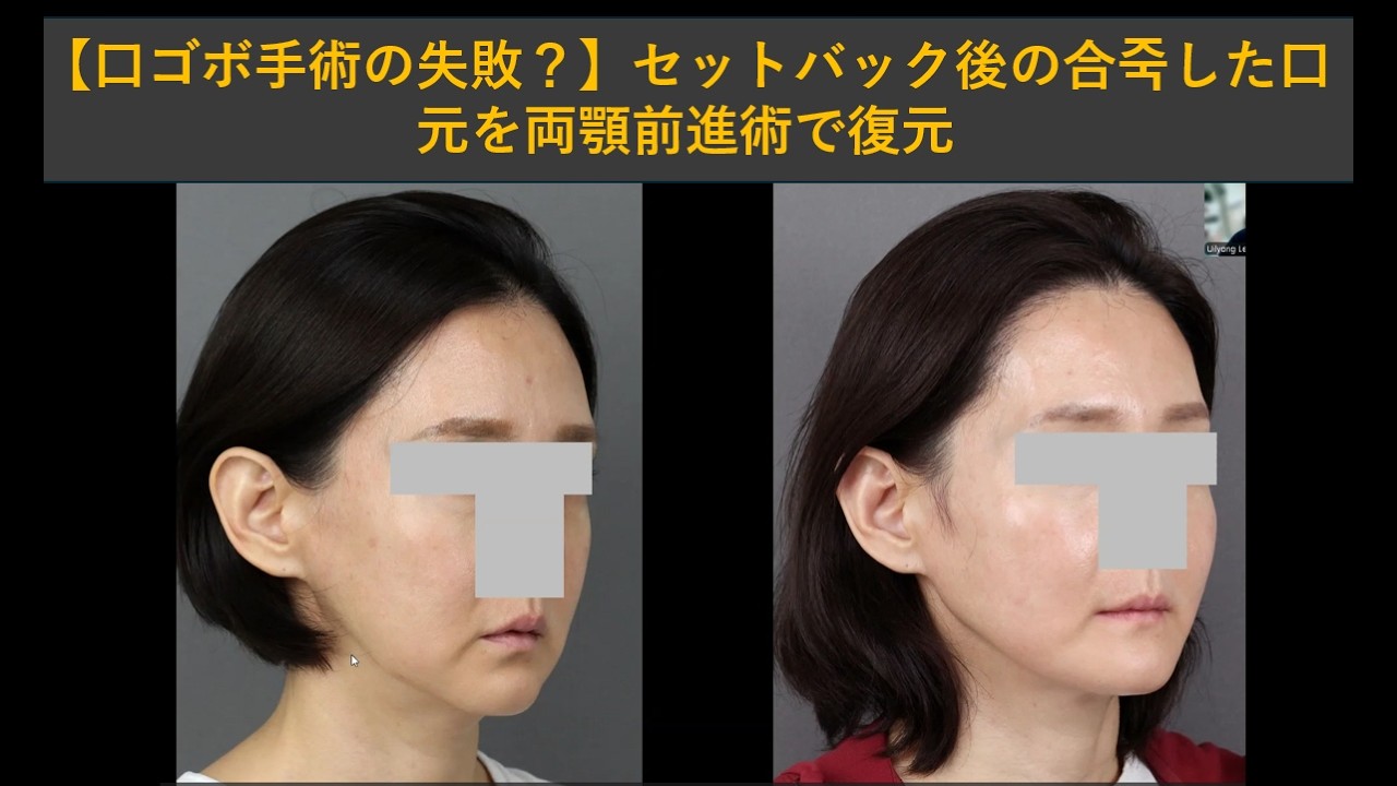 【口ゴボ手術の失敗？】セットバック後の合죽した口元を両顎前進術で復元｜頬骨再配置＋下顎角再建