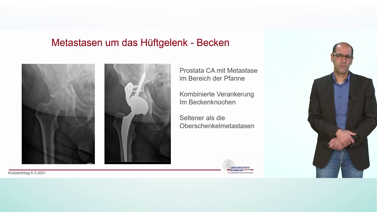 Einsatz der Endoprothetik bei Knochenmetastasen im Gelenkbereich | Prof. Dr. Lukas Konstantinidis
