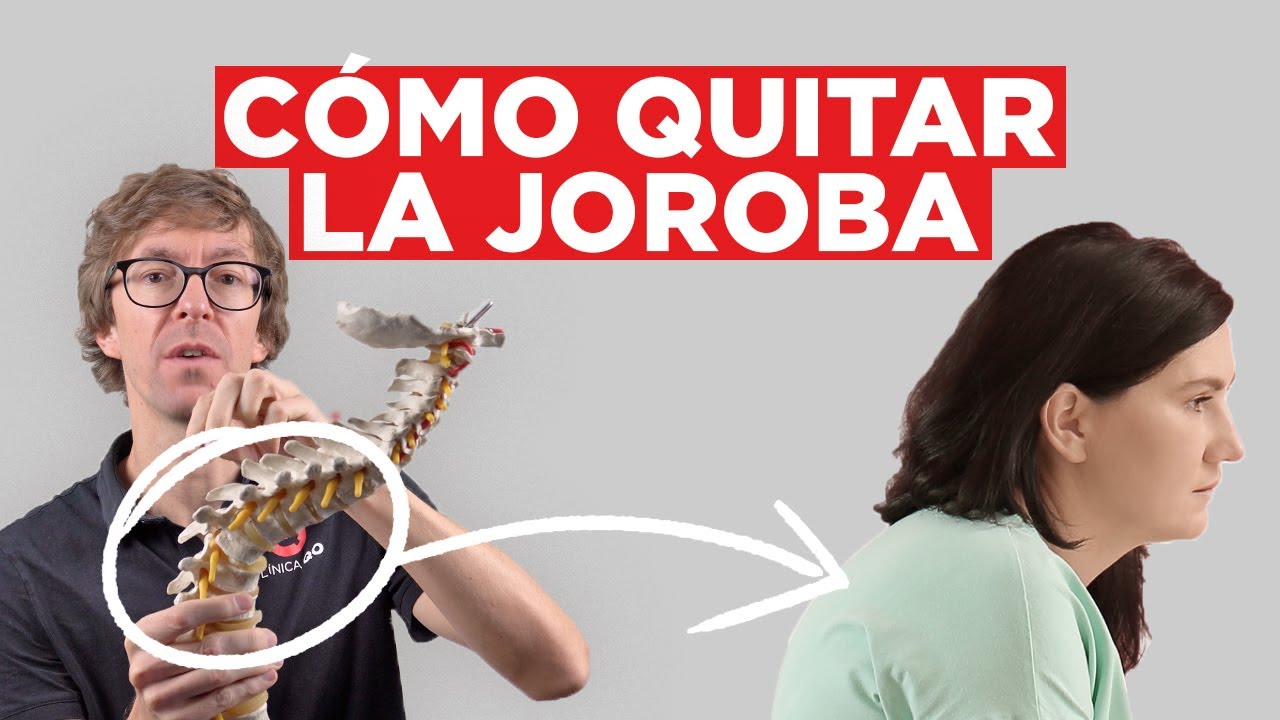 Cómo Eliminar la Joroba de Búfalo | Ejercicios y Consejos