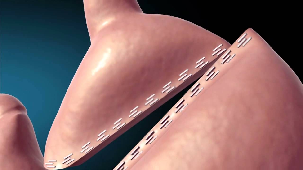 Bypass gastrico