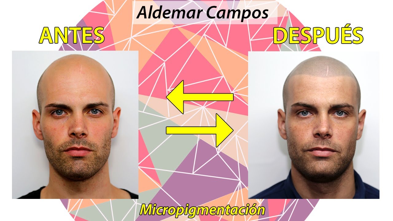 Micropigmentación Capilar  [ENGLISH SUB] Antes y Después