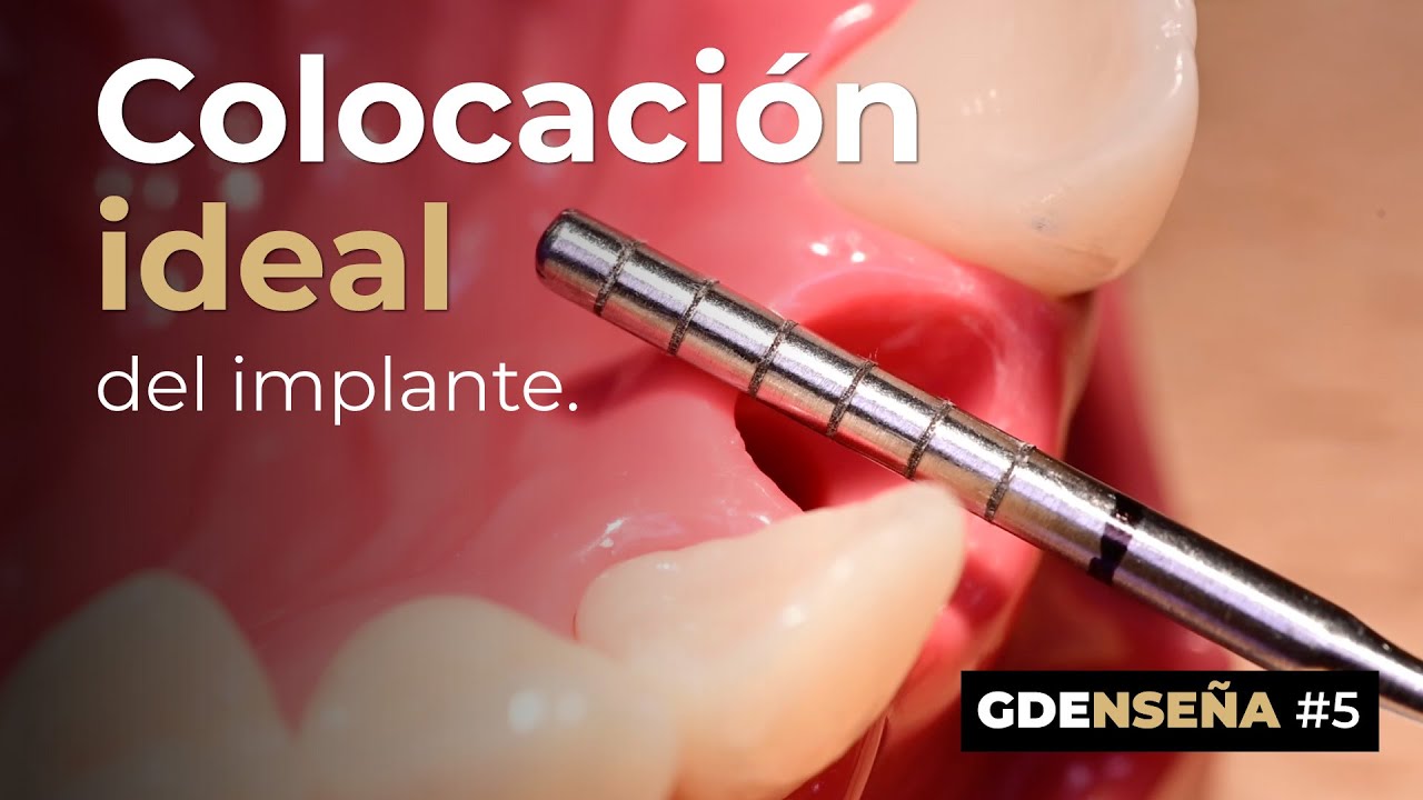 🔎 Colocación ideal del implante. GDENSEÑA #5