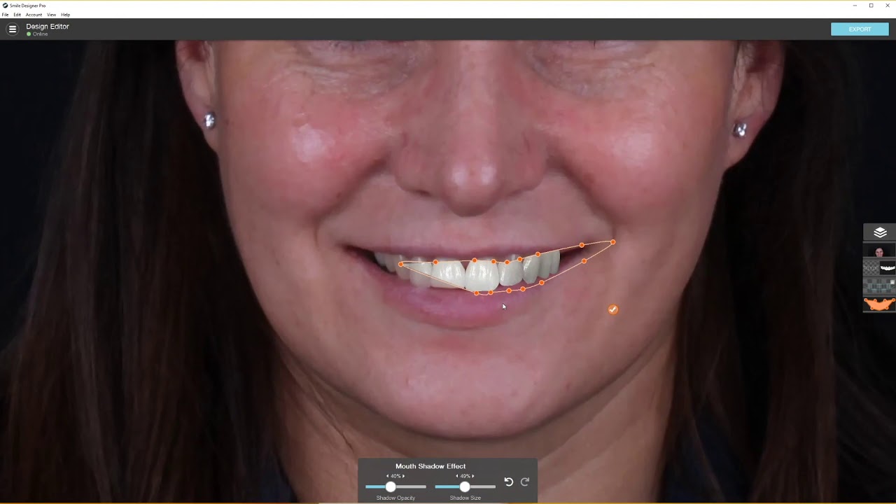 Same Day Digital Smile Design - ExoCAD Nov 2020