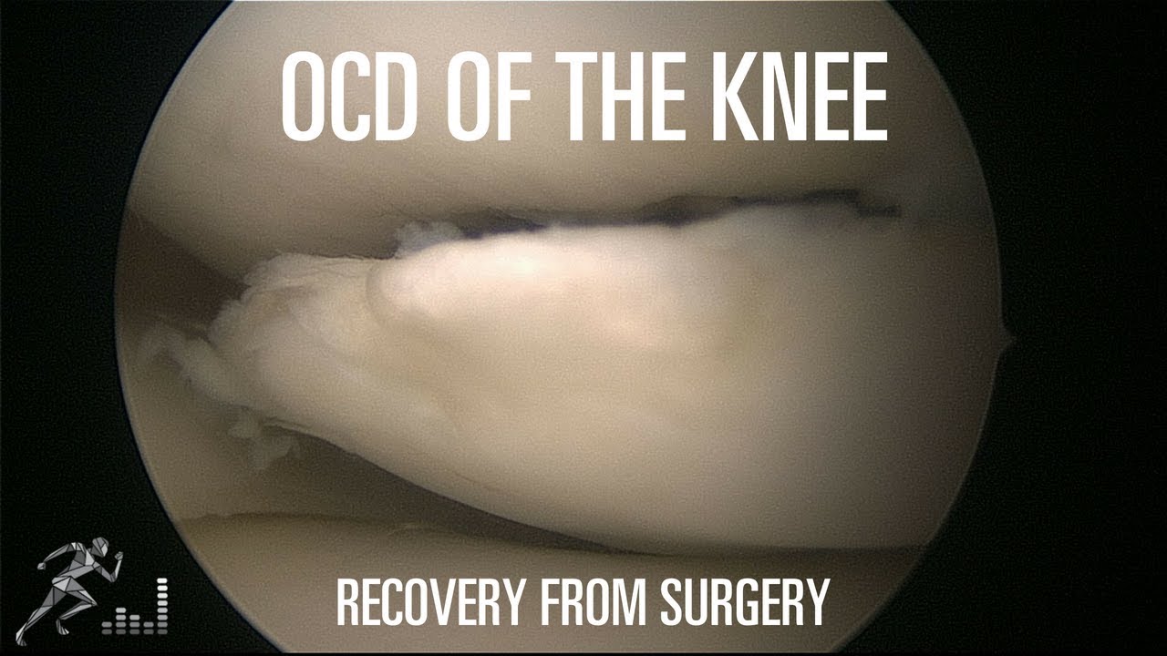 How long does it take to recover from surgery for an OCD lesion of the knee?