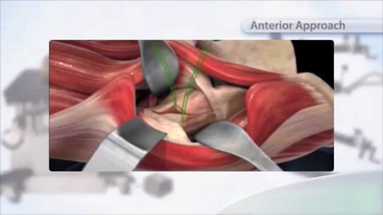 SuperPATH Hip Replacement in Australia