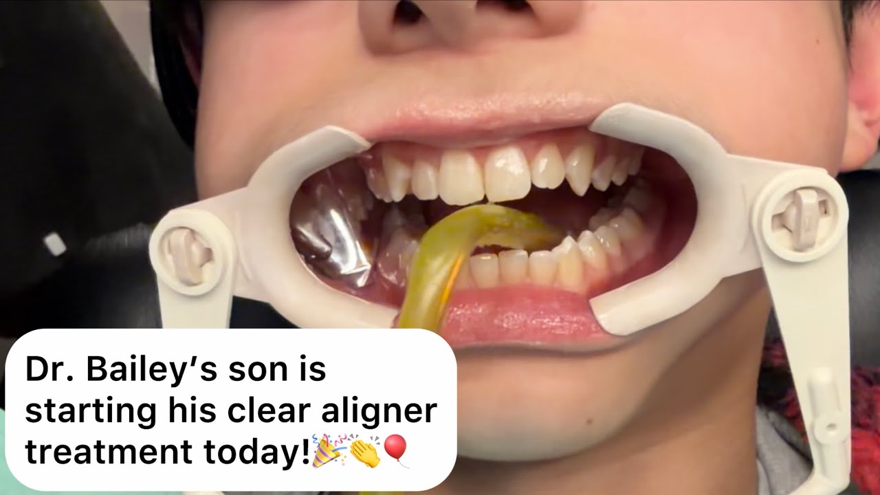 Сыну доктора Бейли установили элайнеры! Насадки Invisalign.