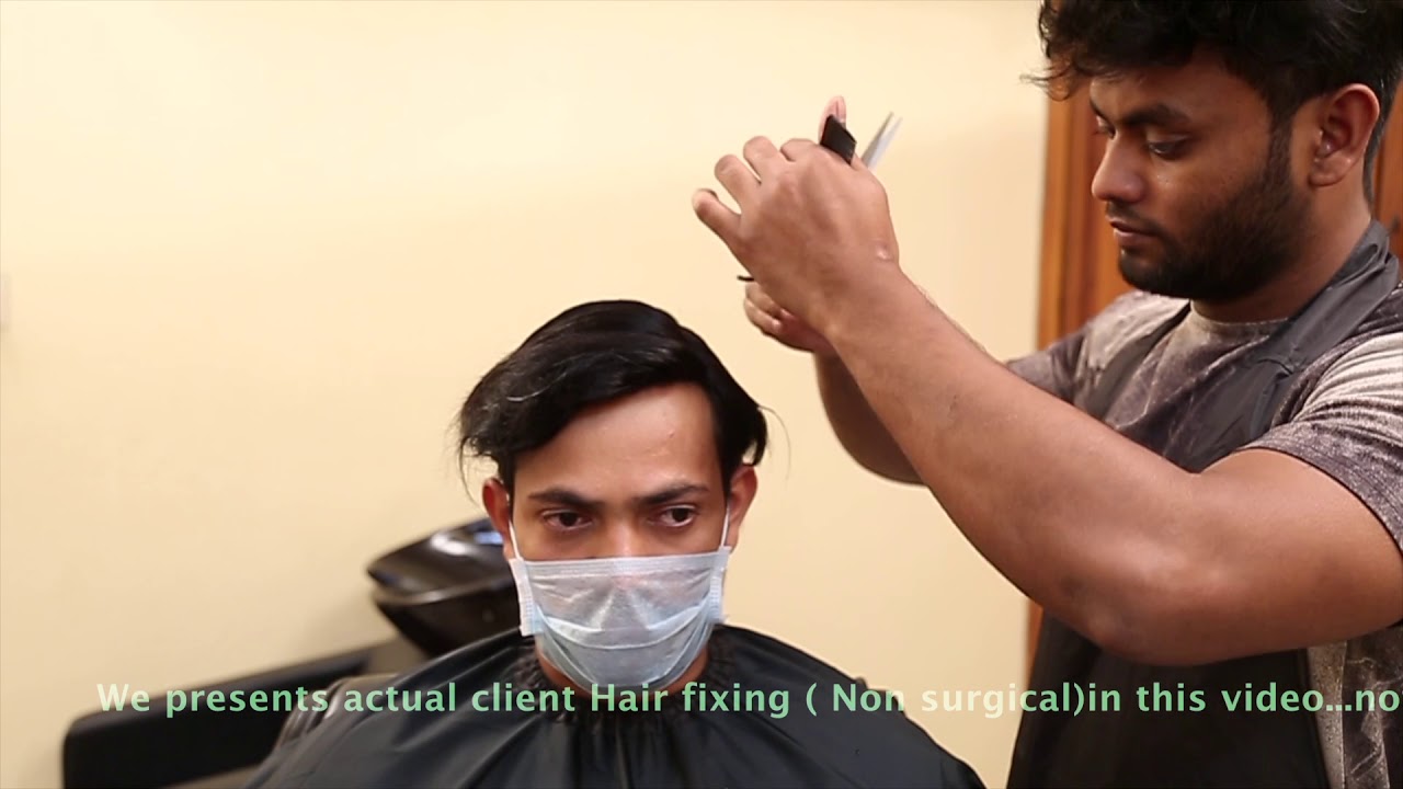 Modern Hair Fixing and Repalcement in Hyderabad 9951223066