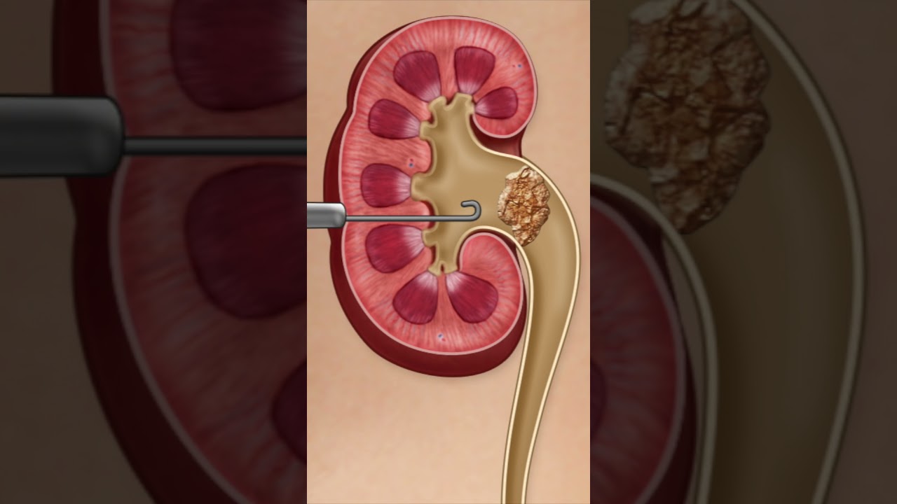 Kidney Stone Procedure - PreOp® Patient Education  #preop #patienteducation #medical  #shorts