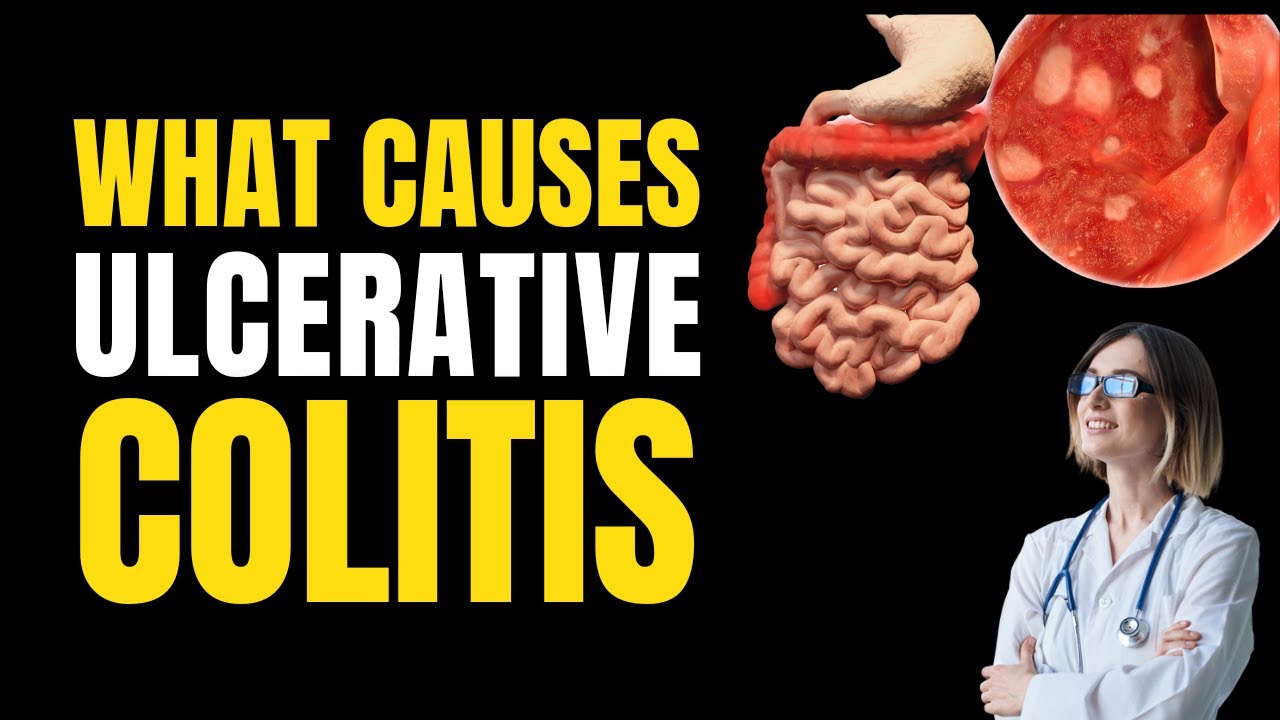 Ulcerative Colitis Root Causes - The Genetic, Environmental, and Immune Puzzle Unveiled!