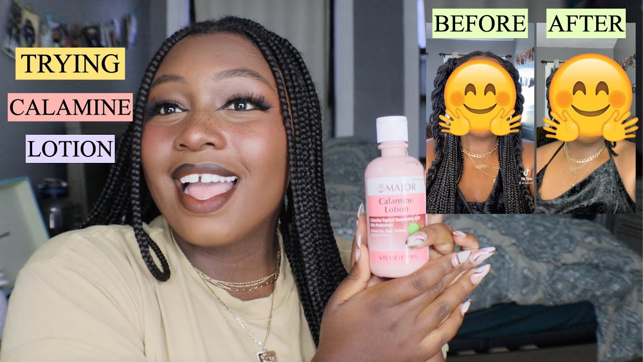 Angel Tries: Calamine Lotion