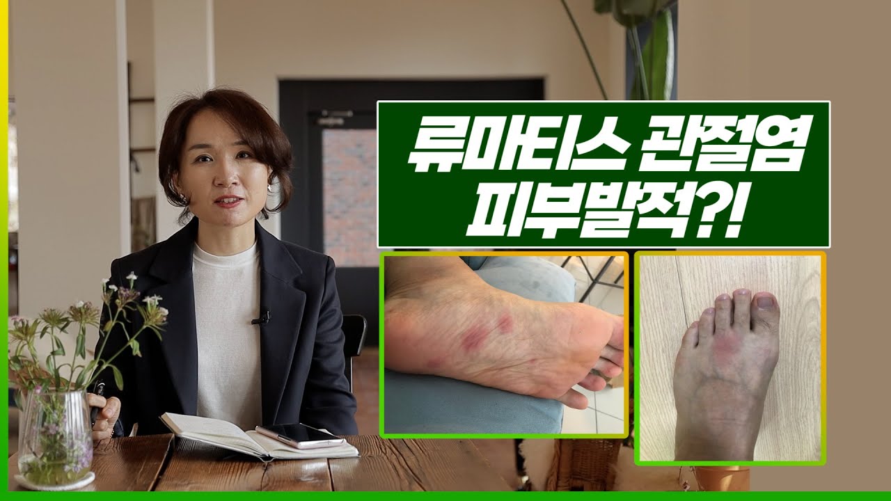 통증 부위에 발적을 동반하는 류마티스 관절염 환자의 개선사례