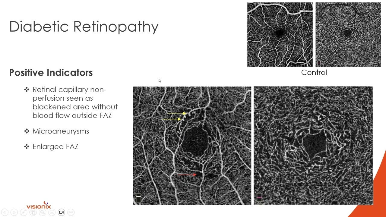 OCT-Angiography 101: Unlocking Vascular Imaging Essentials with Dr. Julie Rodman