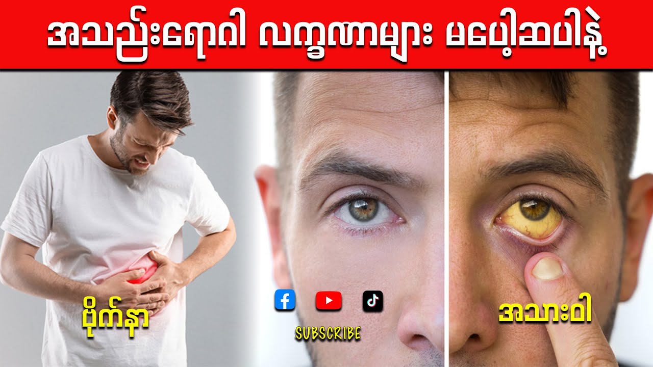 အသည်းရောဂါ လက္ခဏာများ ***အသည်းရောင်ရင် လုံးဝမပေါ့ပါနဲ့***