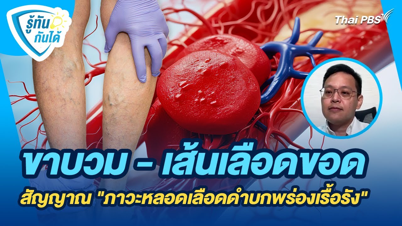 ขาบวม - เส้นเลือดขอด สัญญาณบ่งบอก 