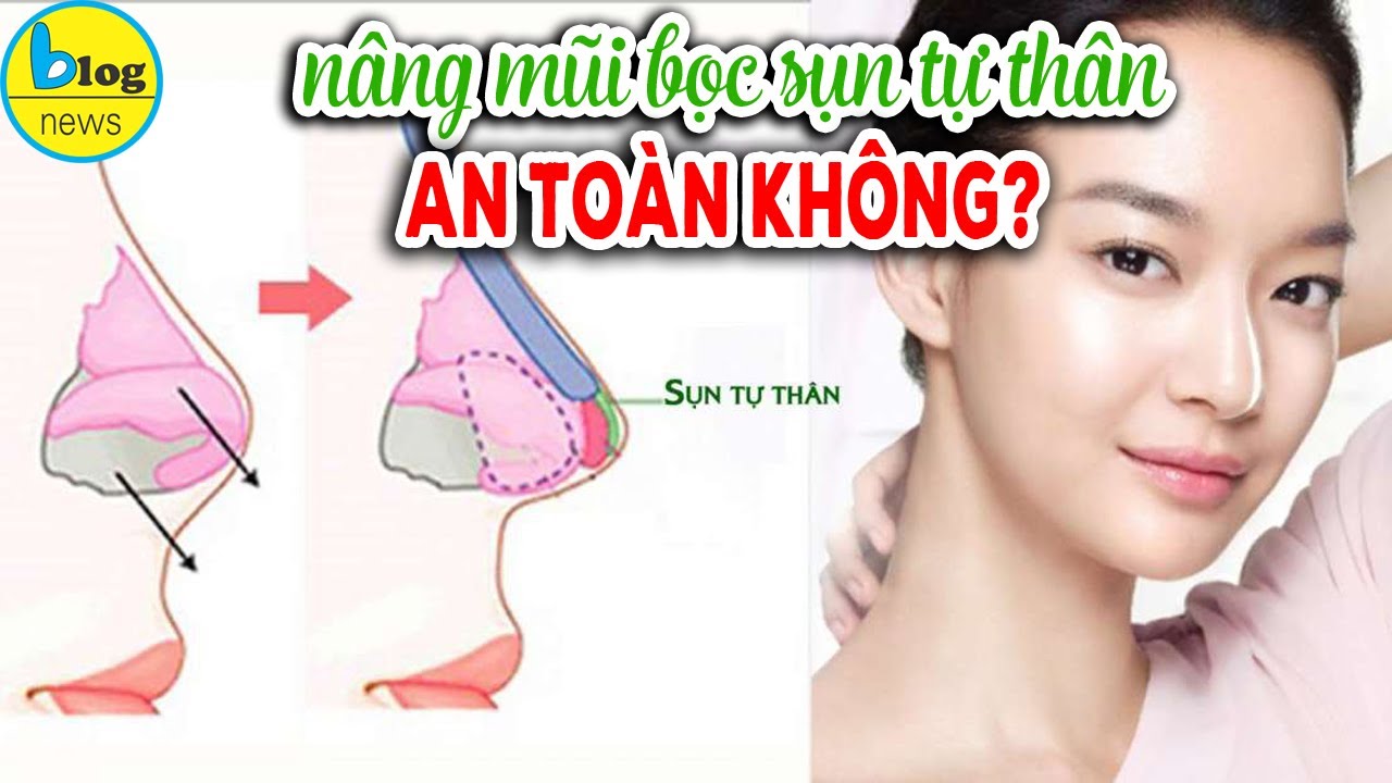 Nâng mũi bọc sụn tự thân đầu mũi như thế nào, có thể gặp biến chứng gì?
