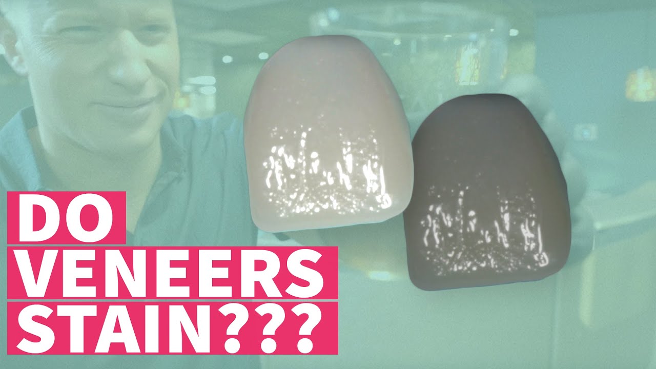Do Dental Veneers Stain? - Expert in Cosmetic Dentistry, Dr. O Shows Amazing Results!