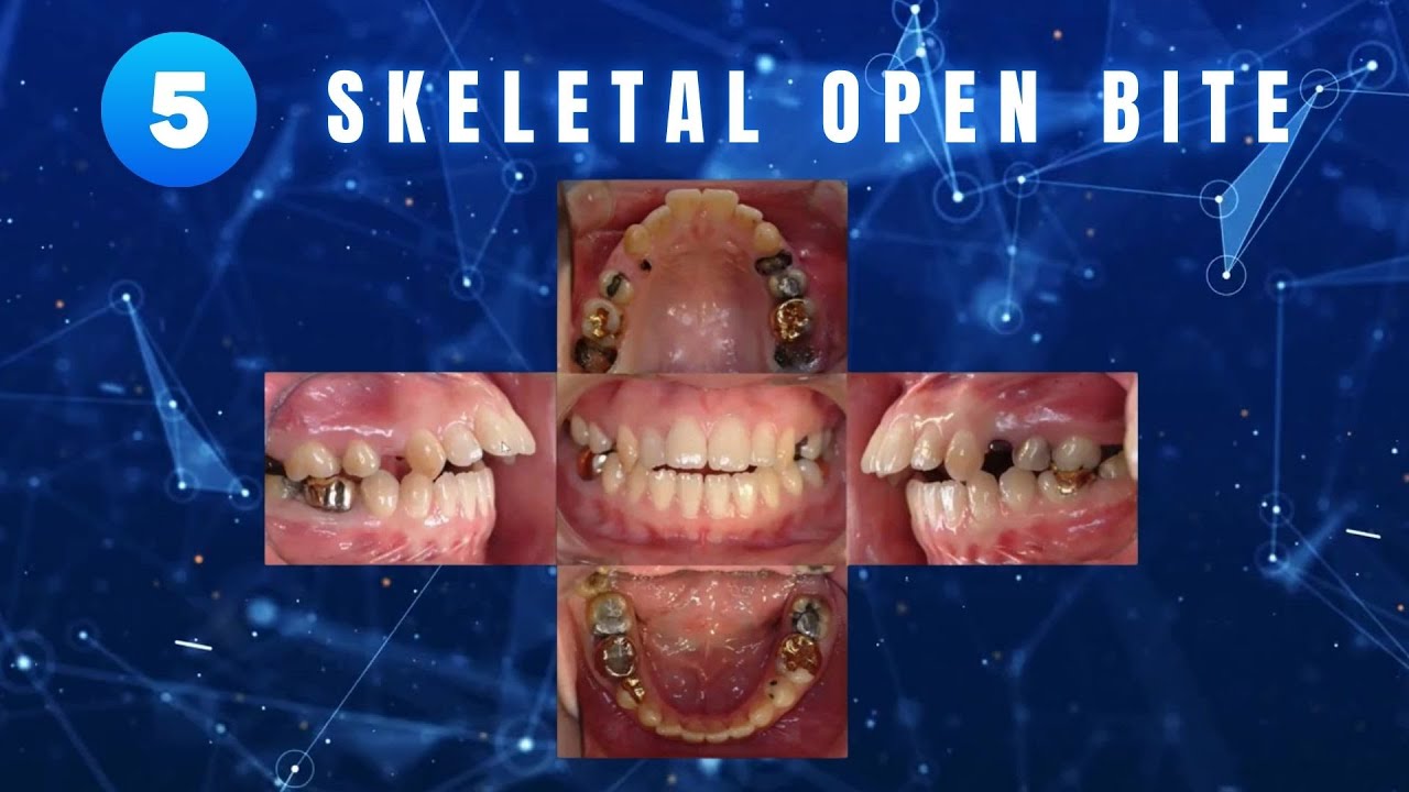 Dr. Chun's case review(5) l Skeletal Open Bite