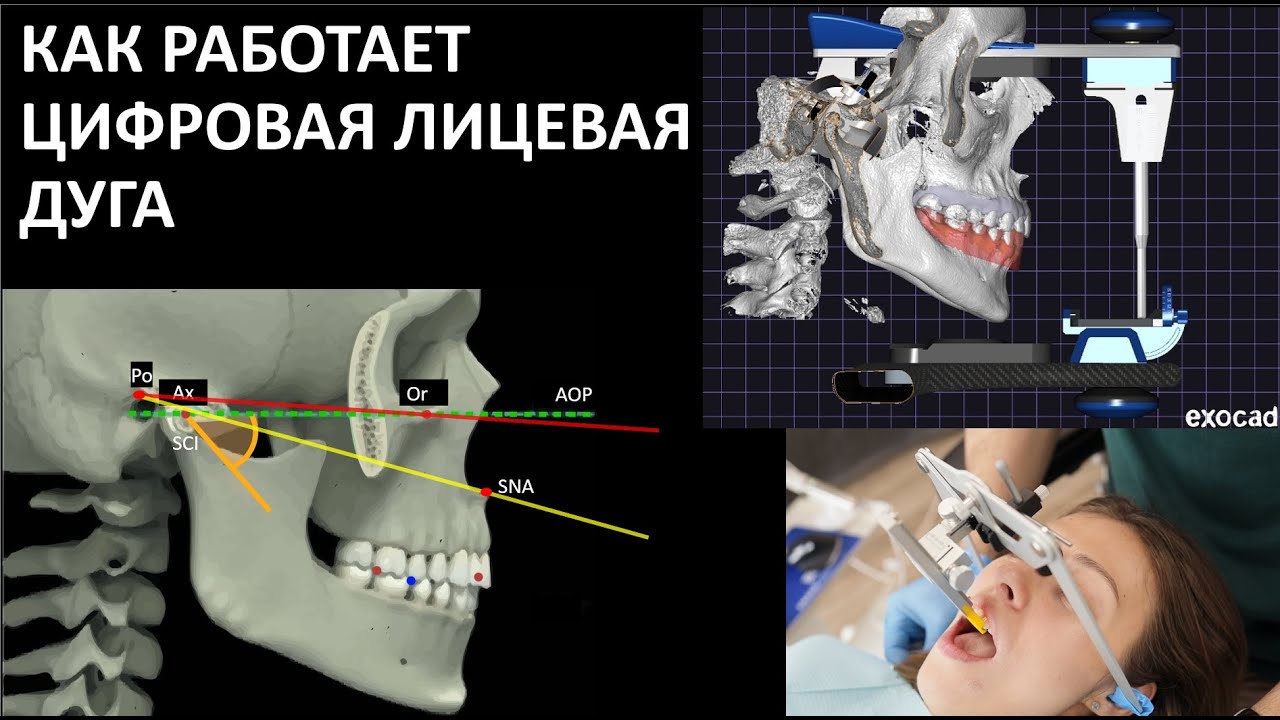 ЦИФРОВАЯ ЛИЦЕВАЯ ДУГА AXIOPRISA facebow